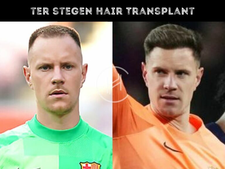 Hair Transplant Before After Result Ter Stegen Goalkeeper 768x576 1