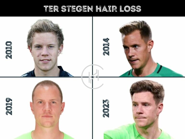 Ter Stegen Hair Loss Transformation 768x576 1