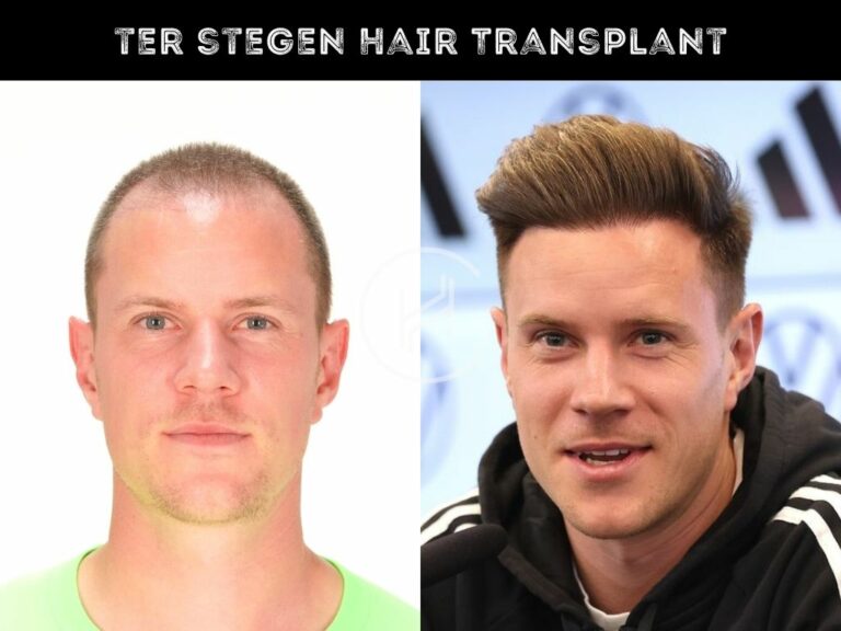 Ter Stegen Hair Transplant Before After Result 768x576 1