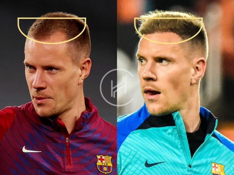 Ter Stegen Hair Transplant Before and After front angle 768x576 1