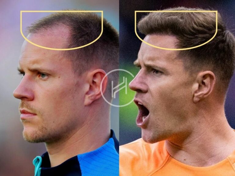 Ter Stegen Hair Transplant Before and After side angle 768x576 1